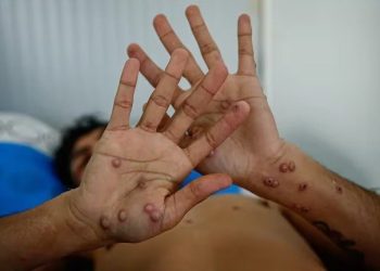 VIRUELA DEL MONO EN ARGENTINA