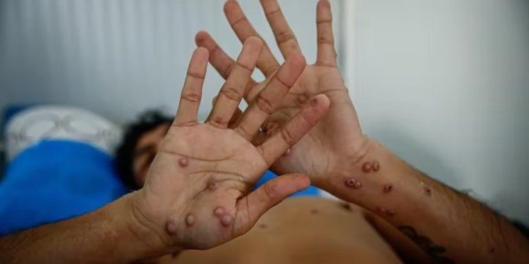 VIRUELA DEL MONO EN ARGENTINA