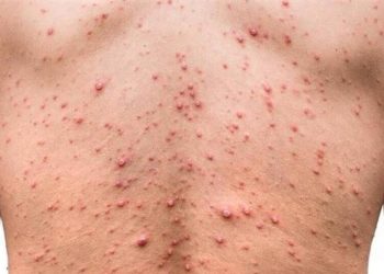 UN JOVEN DE 22 AÑOS ES EL PRIMER CASO AUTÓCTONO DE VIRUELA DEL MONO EN ARGENTINA