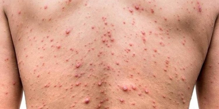 UN JOVEN DE 22 AÑOS ES EL PRIMER CASO AUTÓCTONO DE VIRUELA DEL MONO EN ARGENTINA