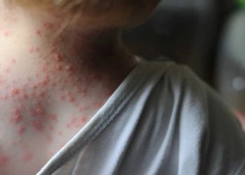 REPORTARON SIETE CASOS NUEVOS DE VIRUELA DEL MONO EN ARGENTINA