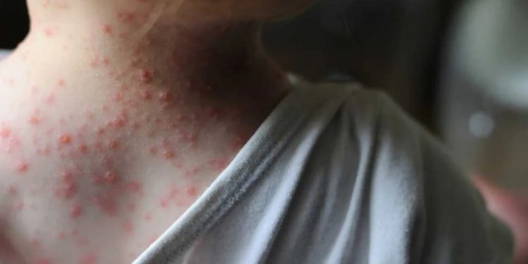 REPORTARON SIETE CASOS NUEVOS DE VIRUELA DEL MONO EN ARGENTINA