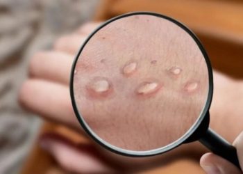 SE REGISTRARON 10 NUEVOS CASOS DE VIRUELA DEL MONO Y YA SUMAN 42 EN LO QUE VA DEL AÑO