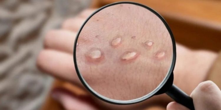 SE REGISTRARON 10 NUEVOS CASOS DE VIRUELA DEL MONO Y YA SUMAN 42 EN LO QUE VA DEL AÑO